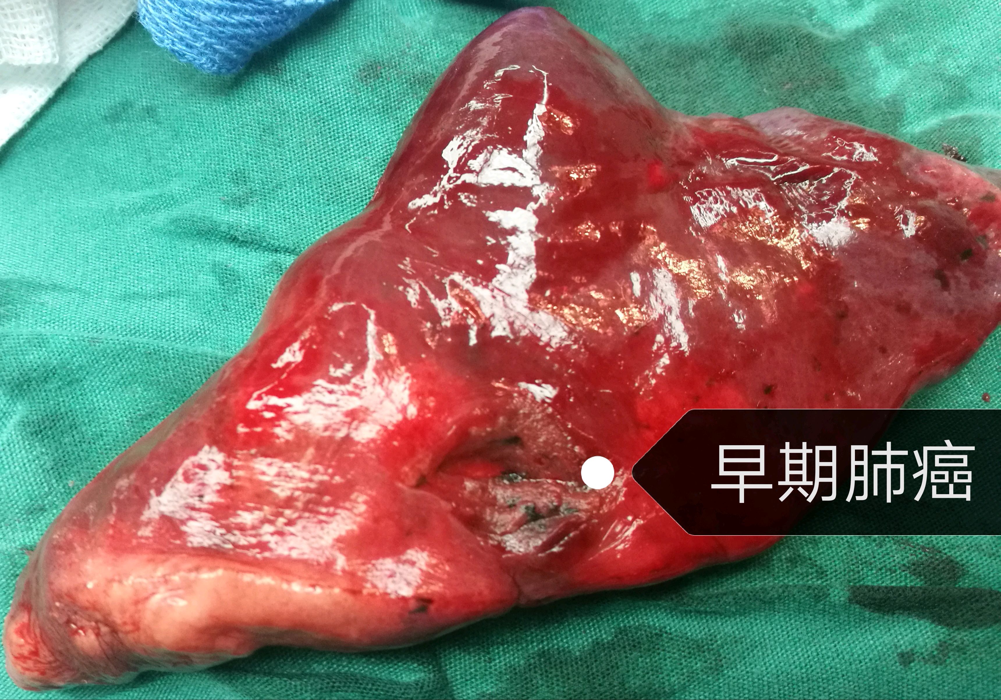 今天为她做了微创手术,结果果然是早期肺癌.
