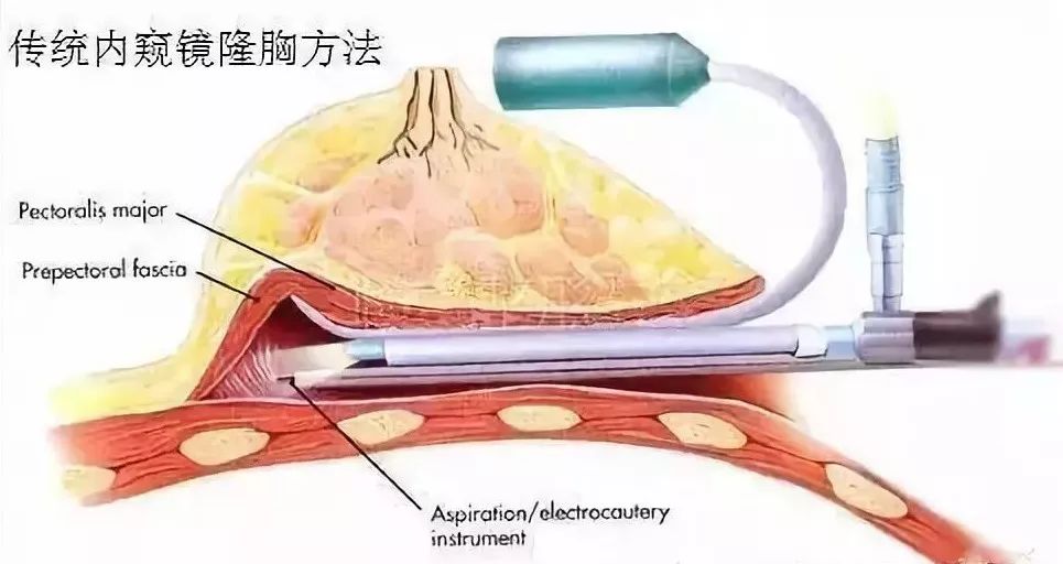 怎样隆胸不那么疼?选择内窥镜隆胸!