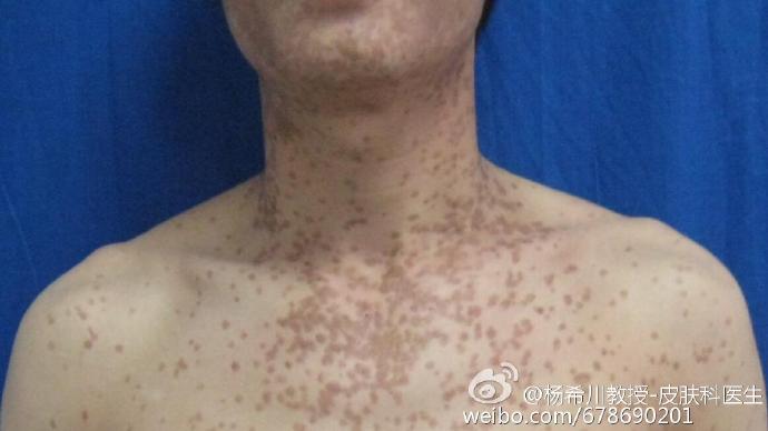 关于扁平疣,你必须了解这8个问题!