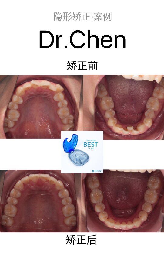 这个女生来之前牙齿有拥挤不齐的情况,在经过隐形矫正不拔牙扩弓,排齐