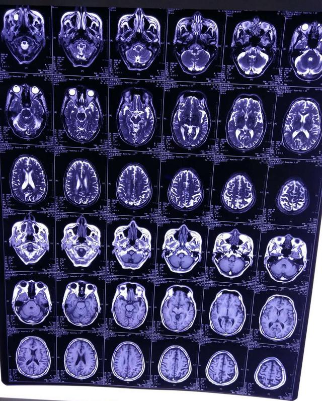 门诊实录脑肿瘤导致的继发性三叉神经痛一例