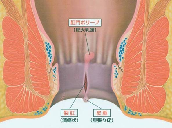 肛裂手术也要讲艺术