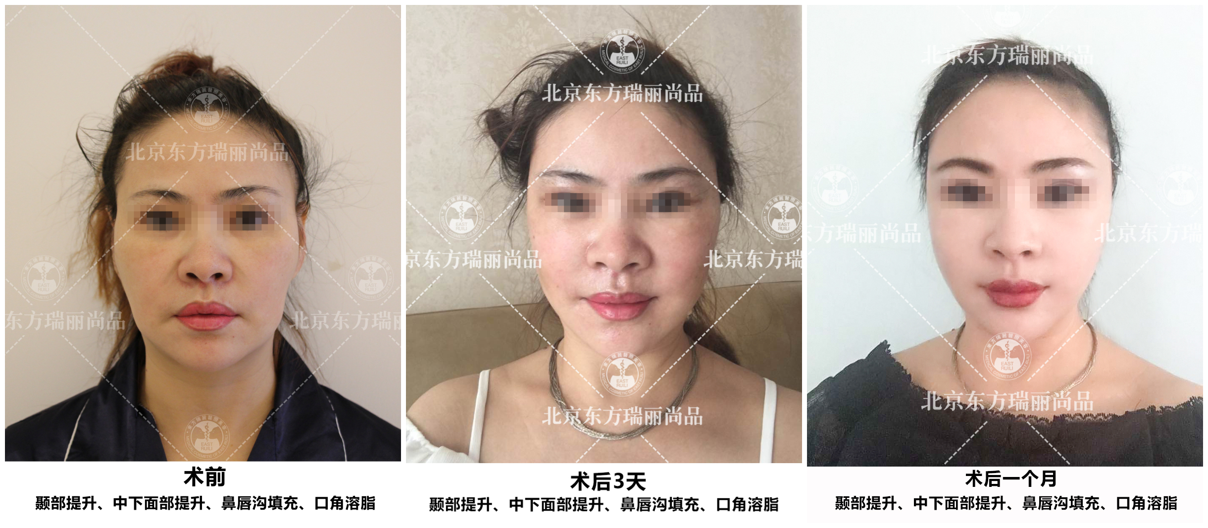 pst面部提升什么时候做比较合适