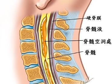 这种囊肿随时间由内向外不断扩大,压迫并损伤脊髓神经组织,导致四肢