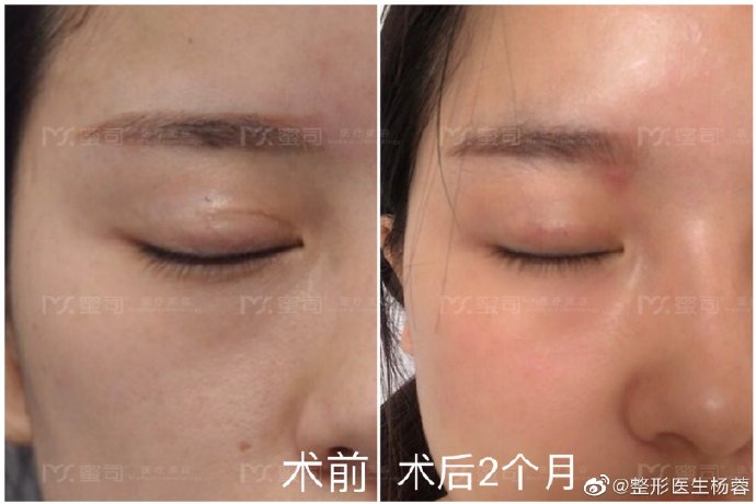 双眼皮手术一年后,眼睛增生了一直没消,有没有办法做修复?