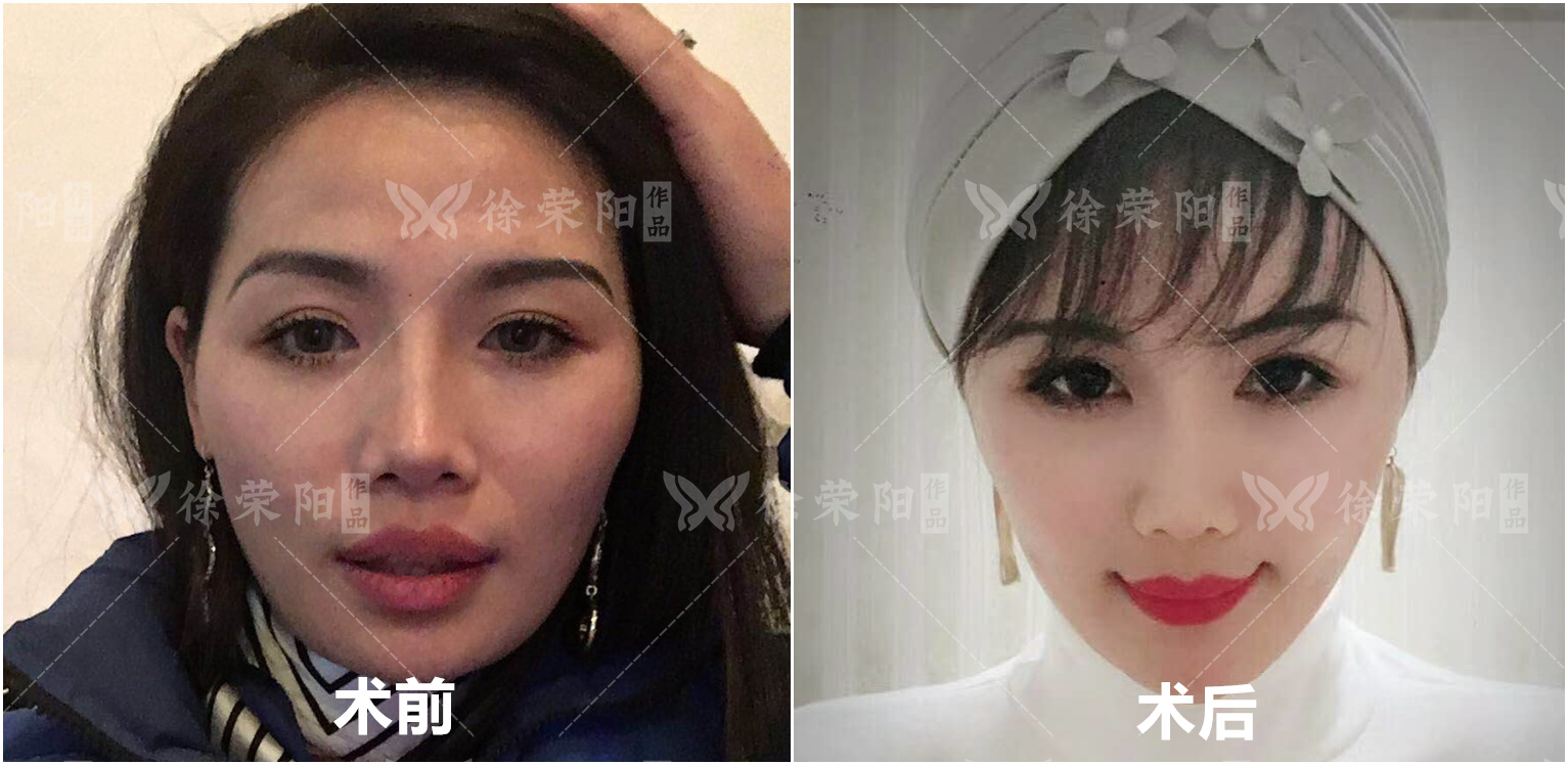 常伴有鼻背隆起的