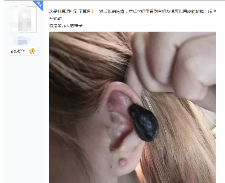 耳朵瘢痕疙瘩真的能勒掉吗?