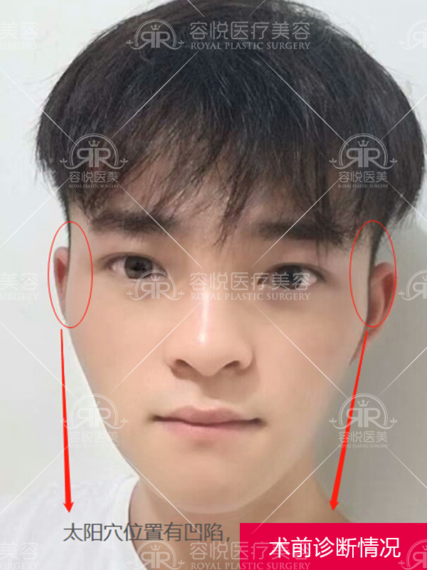 玻尿酸填充太阳穴方案规划和说明