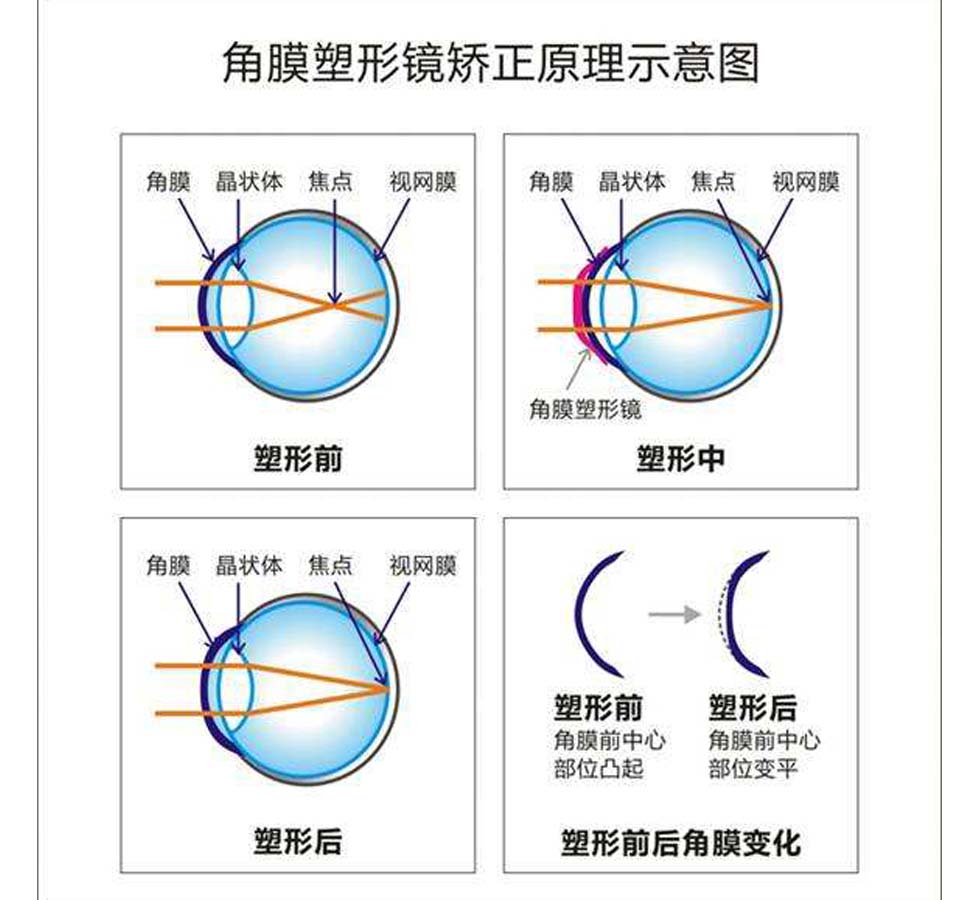 角膜塑形镜是一种硬性角膜接触镜,夜戴晨取,白天可以裸眼清晰看世界
