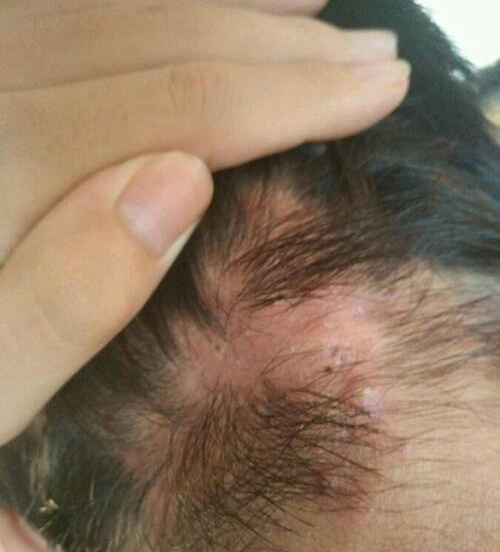 痤疮和毛囊炎有何区别?