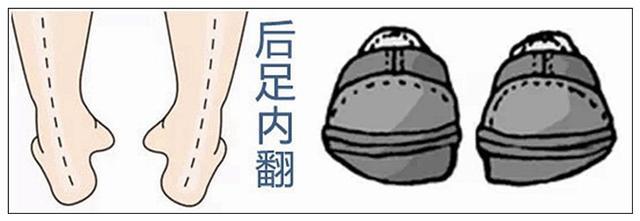 足内翻图片