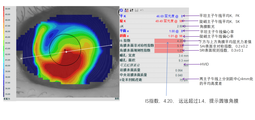 角膜地形图具体参数详解