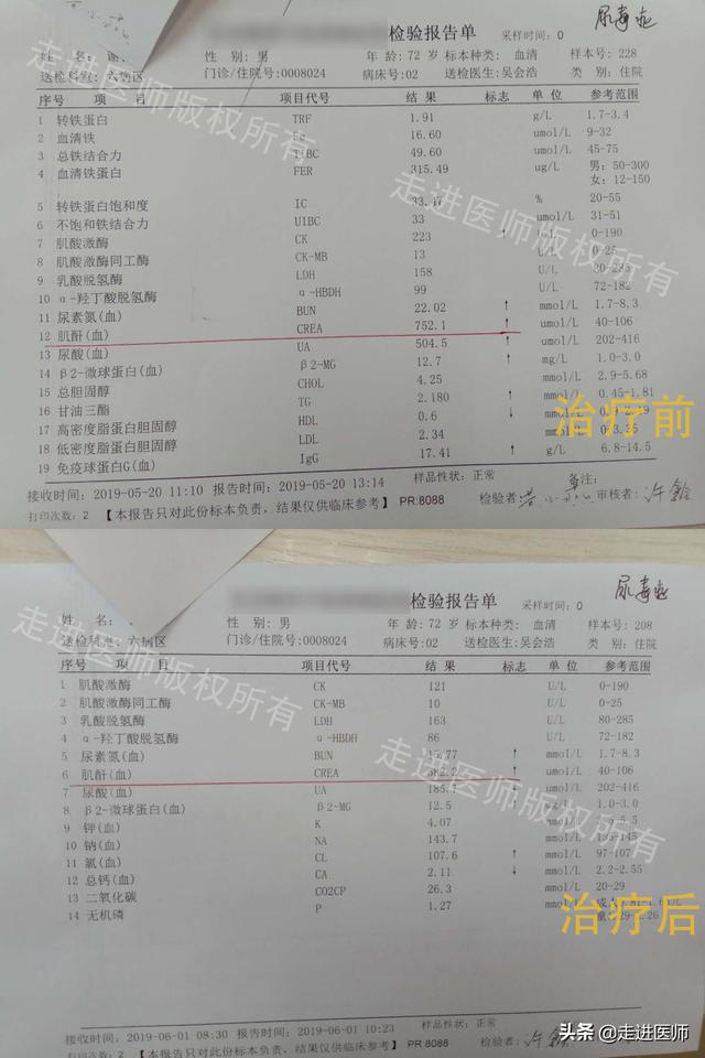 尿毒症患者肌酐七百多,住院治疗仅11天,肌酐了二百多