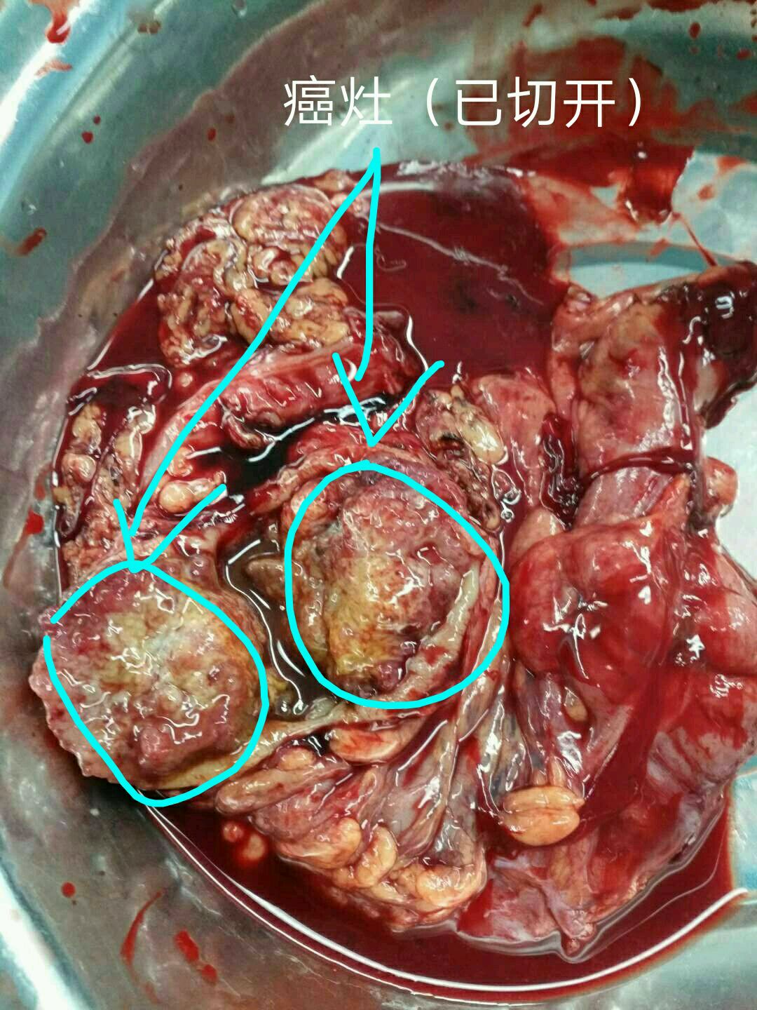 结肠肝曲癌,这是一位右中上腹反复疼痛,体重急剧减轻,大便潜血,肠梗阻