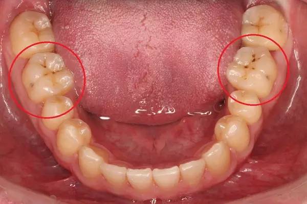 龋齿俗称虫牙蛀牙是怎么产生的