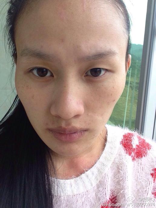 皮肤好差好差 长痘又长斑 这怎么出门啊?