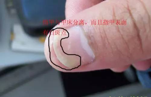 指甲与指甲片下方的指甲床松动的初期症兆,指甲远端白色弧形区域形状