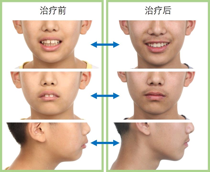青少年上颌前突,下颌后缩畸形的矫正