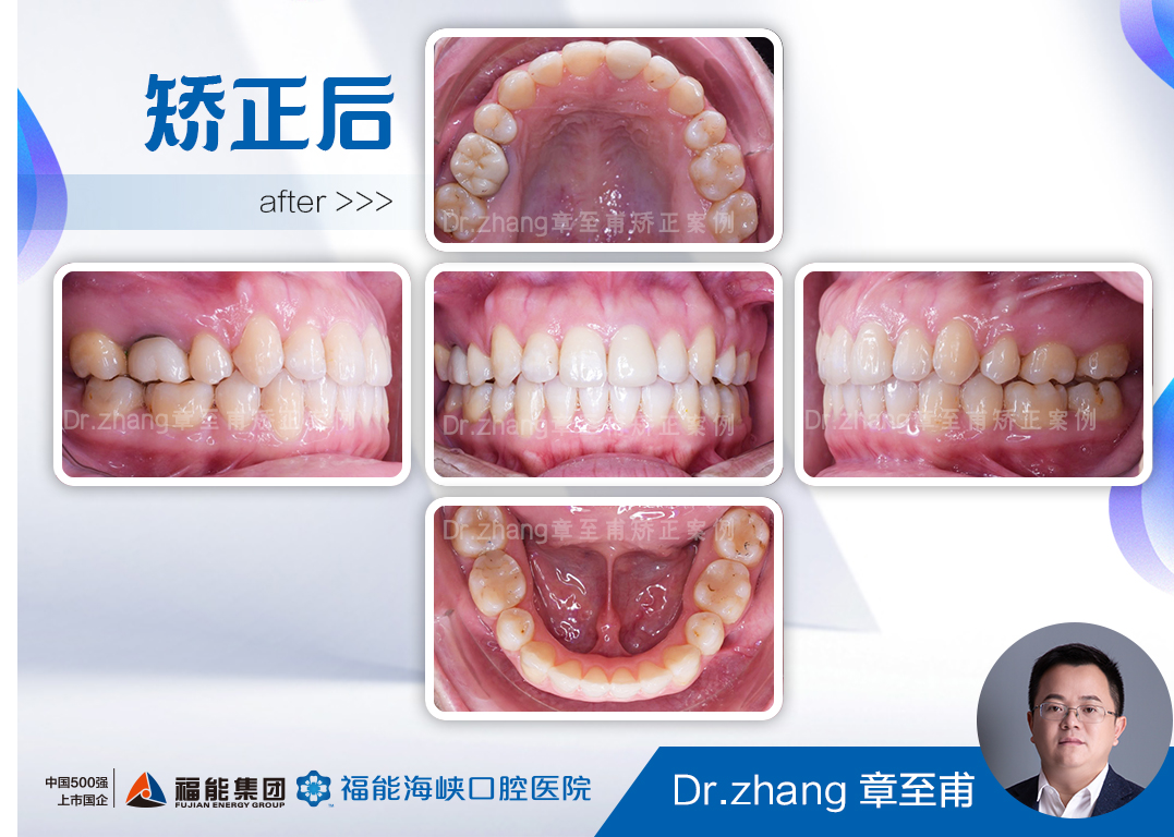 隐适美隐形矫正1年完成案例