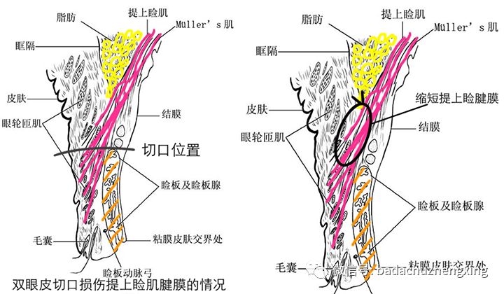之所以要说双眼皮和上睑下垂存在密切联系,这事要从一个重要的结构