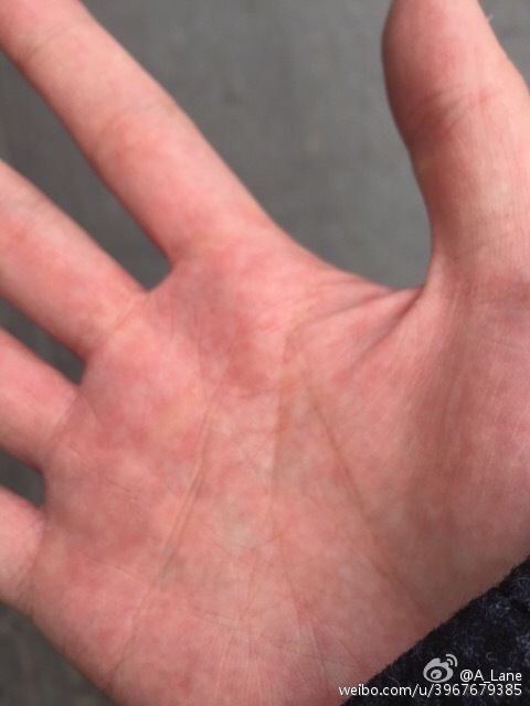 手掌发痒是什么原因?肝功能?