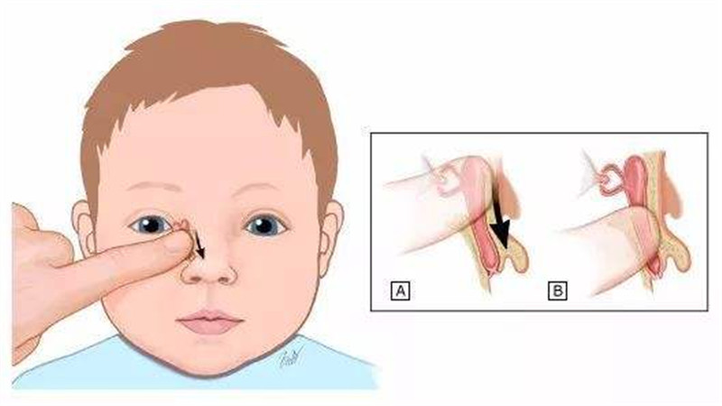 对于新生儿鼻泪管堵塞,是由于其上方的入口被黏膜覆盖,这些黏膜是由于