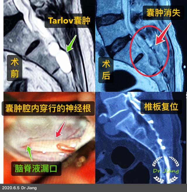 2.骶管囊肿会产生症状吗?   3.骶管囊肿需要处理吗?   4.