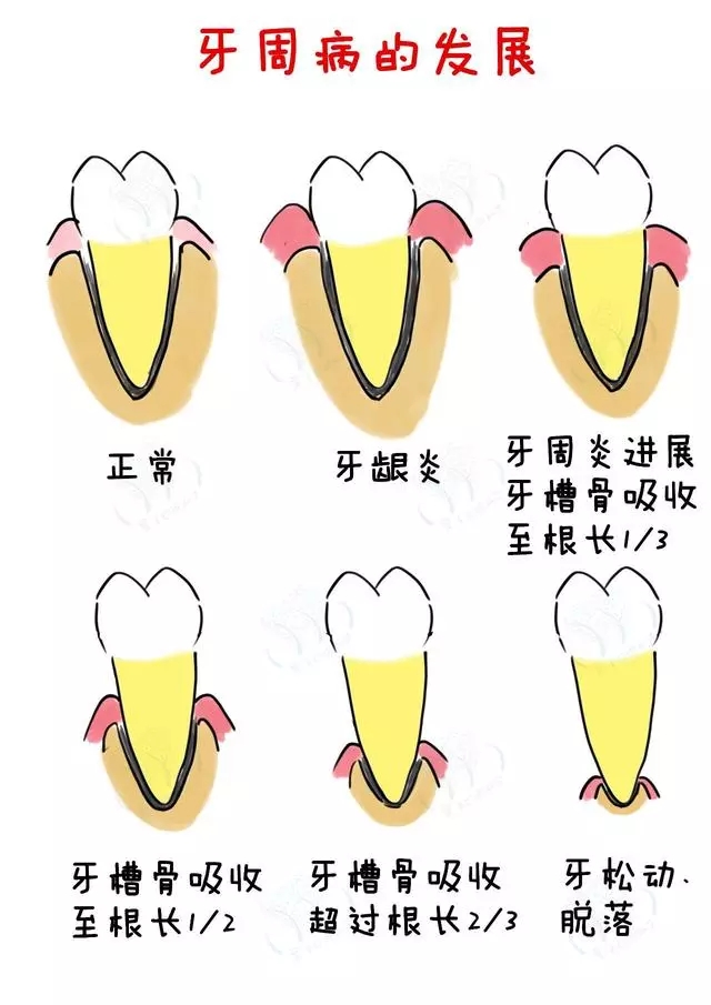 我们可以通过下图简单了解牙周病造成的危害