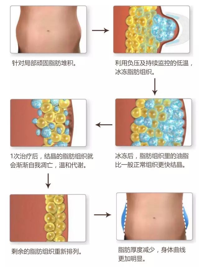 酷塑冷冻溶脂,轻松健康"享瘦"