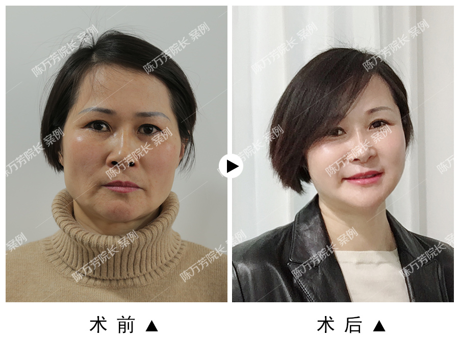 陈万芳讲脂肪6脂肪能解决面部皱纹凹陷等衰老现象吗