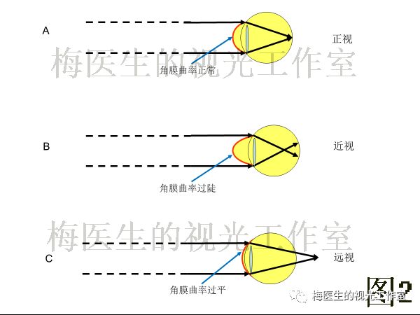 图1 眼的屈光状态由角膜曲率,眼轴,晶状体屈光力决定眼轴增长使眼球