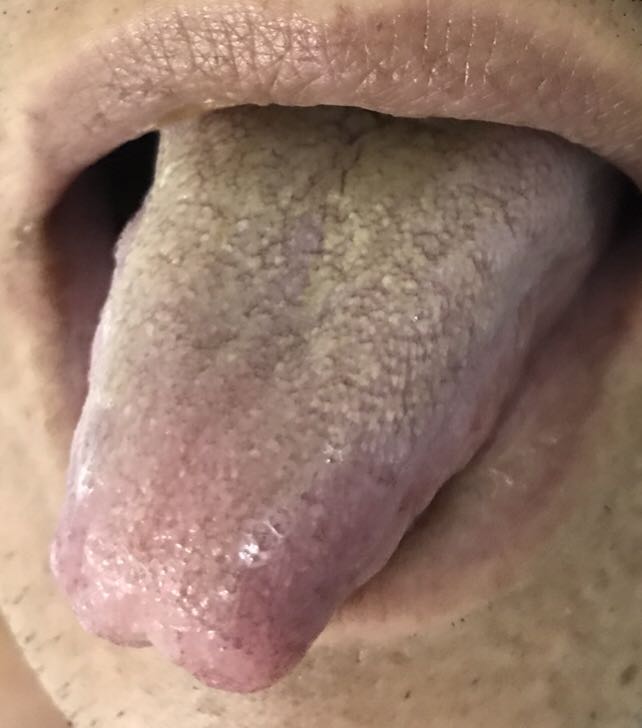 舌苔滑,黄腻,中间有裂痕,主脾胃湿热,湿热病重.