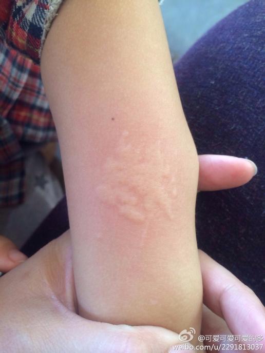 三岁,这两天发烧可伴随着四肢起这种疹子,请问这是过敏吗?谢谢
