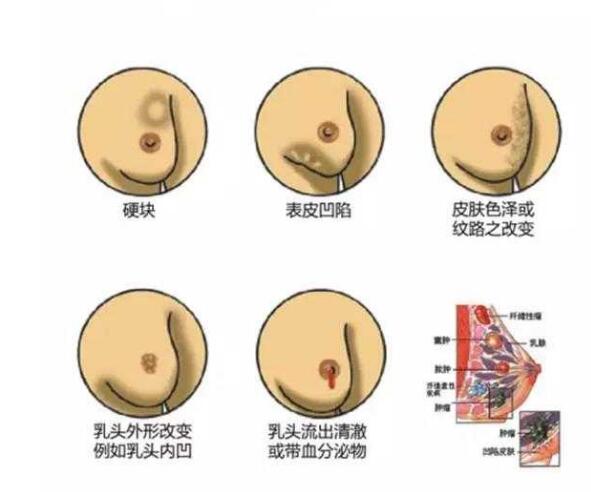 乳腺增生患者孙某双乳房结肿块,以胀痛,隐痛为主,该怎样解决