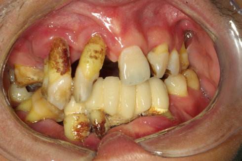 牙结石是如何一步一步破坏你的牙齿的?