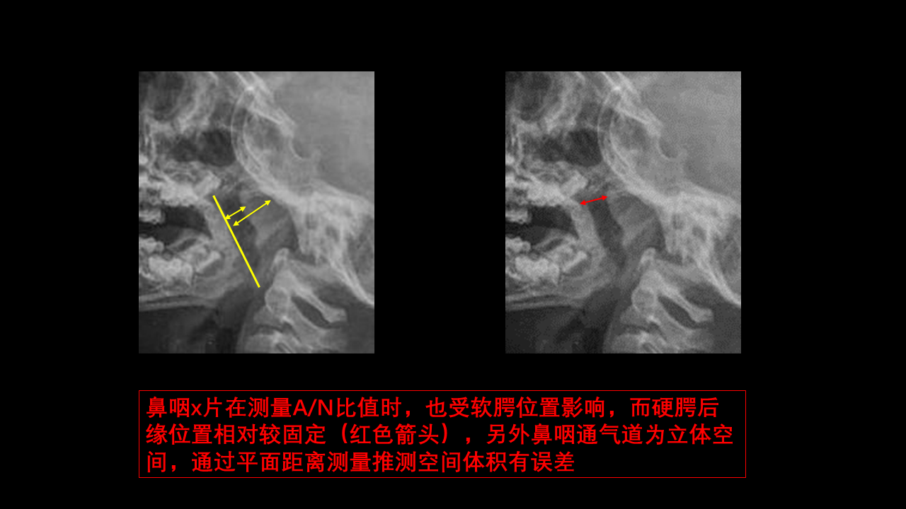 腺样体肥大程度的判断方法