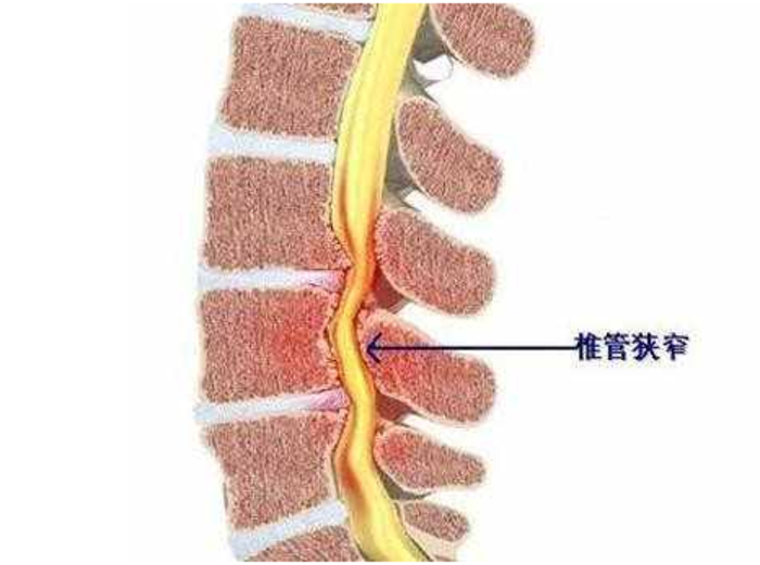 当滑脱的腰椎导致神经根受到牵拉时,患者会出现下肢疼痛麻木症状.