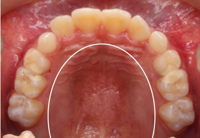 牙弓狭窄腭部高拱隐藏的儿童牙颌面部发育异常