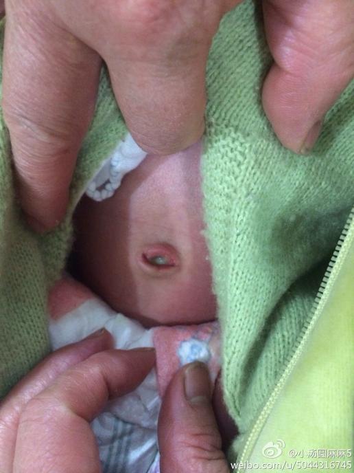 我家小宝出生17天,脐带脱落了,但现在肚脐眼里面有白色粘状物(见图片)