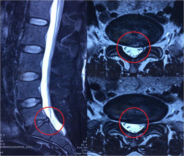腰椎间盘突出症腰腿疼痛难忍椎间孔镜手术解除病痛