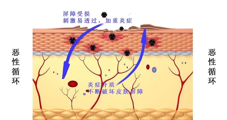 皮肤屏障受损严重;炎性反应会加重皮肤屏障的破坏,皮肤屏障的不完整
