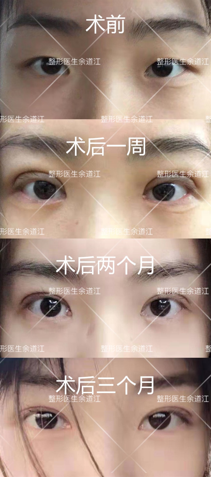 全切的优化与改进:park法双眼皮