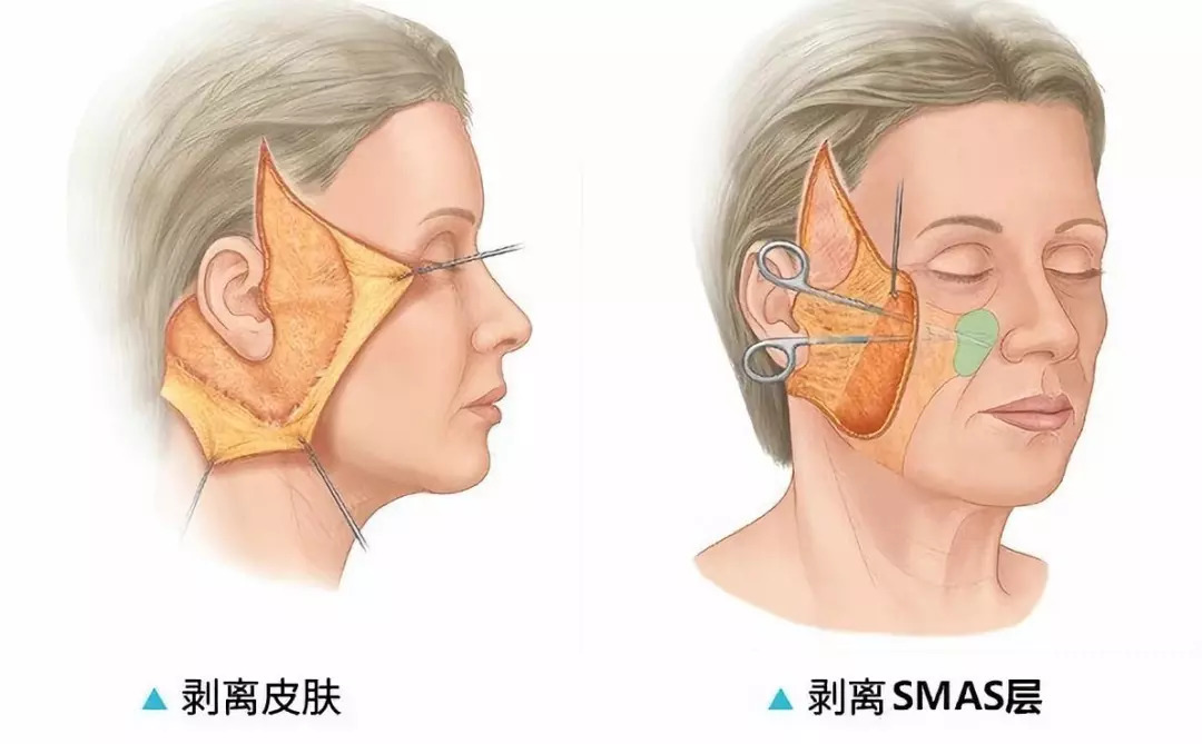 都说smas提升抗衰你真的了解什么是smas吗