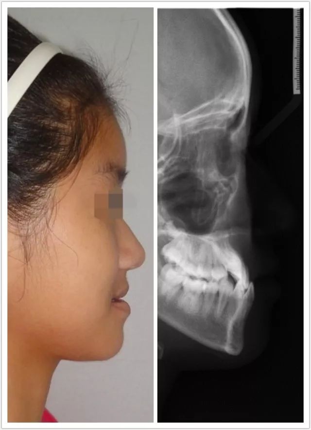 一个地包天患者的6年矫治历程