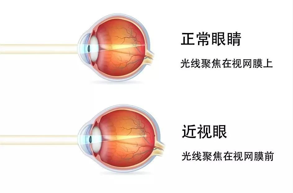 近视,是由于先天或后天因素(如不注意用眼卫生),使眼球前后径(即眼轴)