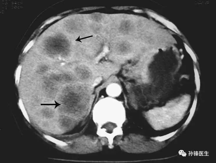 医学小品肝脏多发囊肿和肝脏转移瘤怎样鉴别