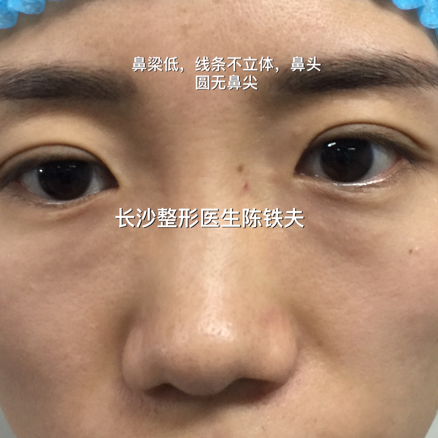 鼻子的整形--鼻综合