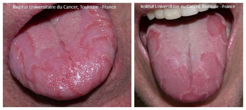 口咽部念珠菌是口腔最常见的感染.