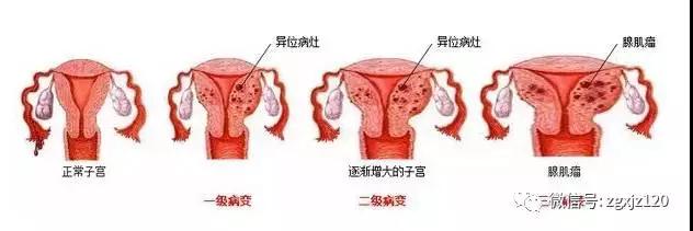子宫腺肌症月经干净后,下体有水样分泌物排出,怎么回事?