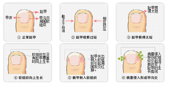 医生亲身体验甲沟炎秘方真实有效